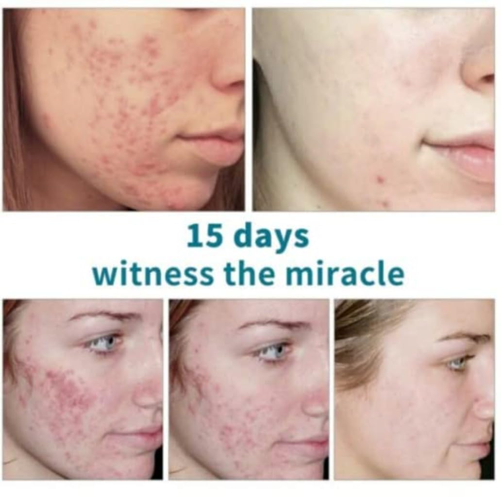 Crema Para El Acne ELIMINA Barros Espinillas Y Manchas RECUPERA Tu Piel LINDA