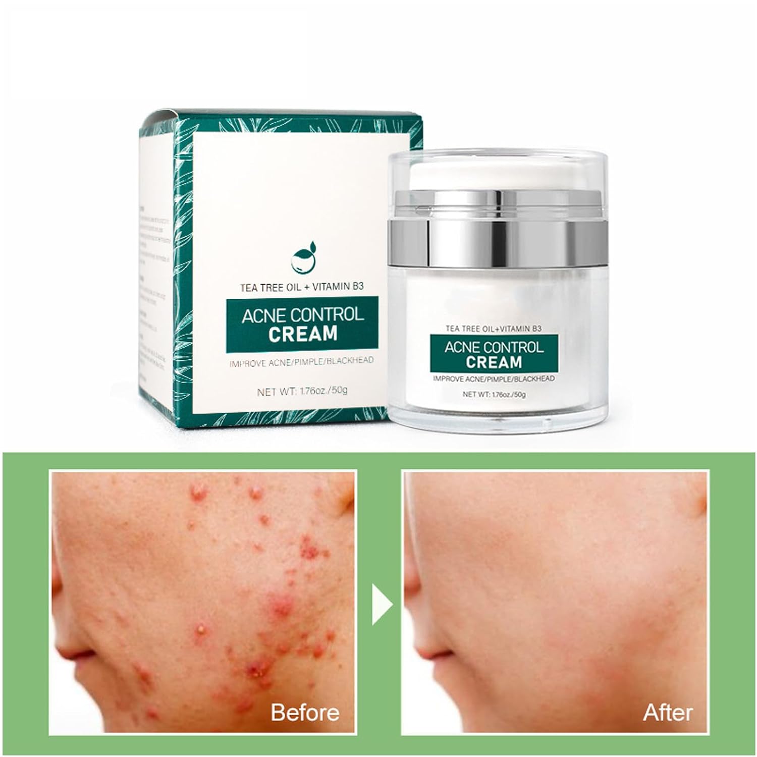 Grospe Anti Acne Cream Face Cream.Natural Ingredients Professionally Remove Acne Marks.Gently Reduce Acne For Teens & Adults Anti-acne Moisturizer Pimple Cream : Beauty & Personal Care