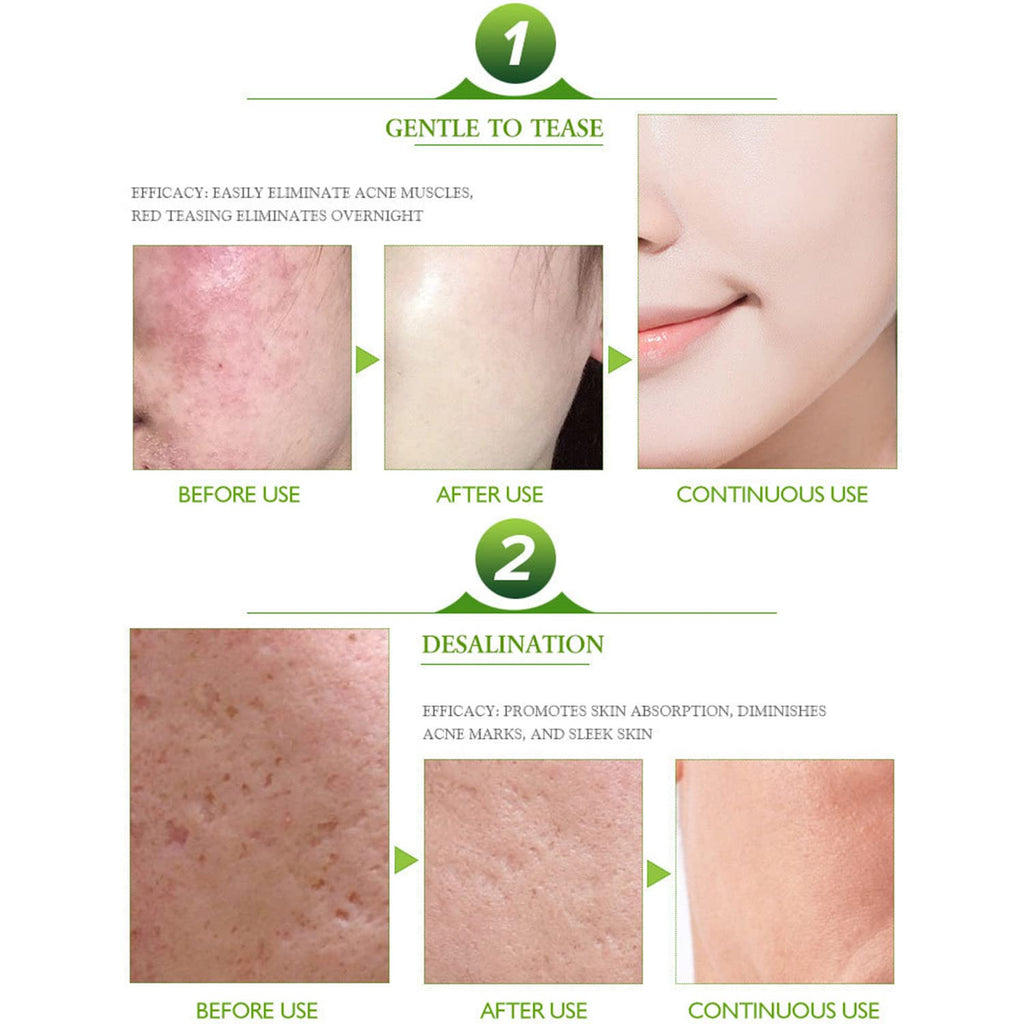 Face Acne Cleaning Cream Skin Care Remove Repair Comedone Pimple Acne Face Acne Cream 30ml/1.0fl.oz : Beauty & Personal Care