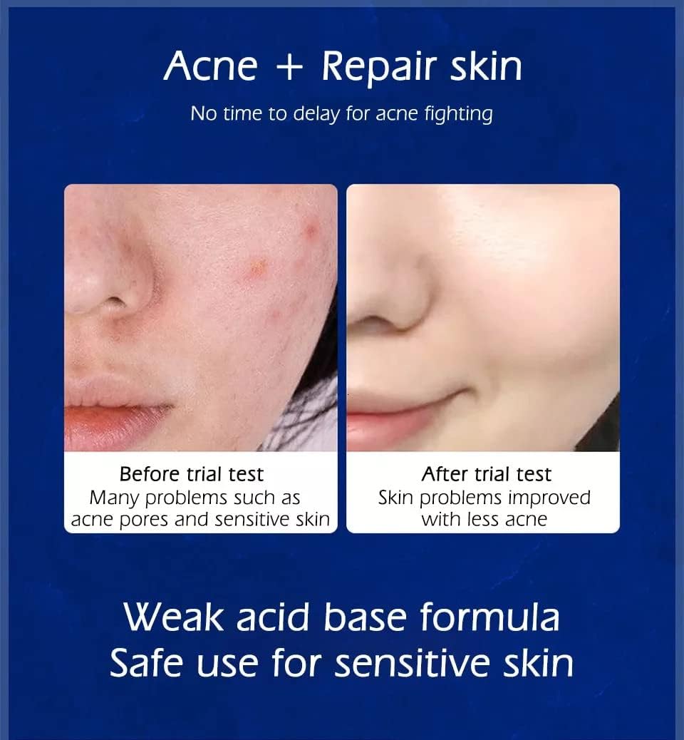 Cystic. Hormonal. Severe Acne Treatment Cream for Teens & Adults with Hyaluronic Acid Aloe Vera Oil Overnight Cystic . Unisex Sensitive Skin Blind Pimple & Blemish Remover