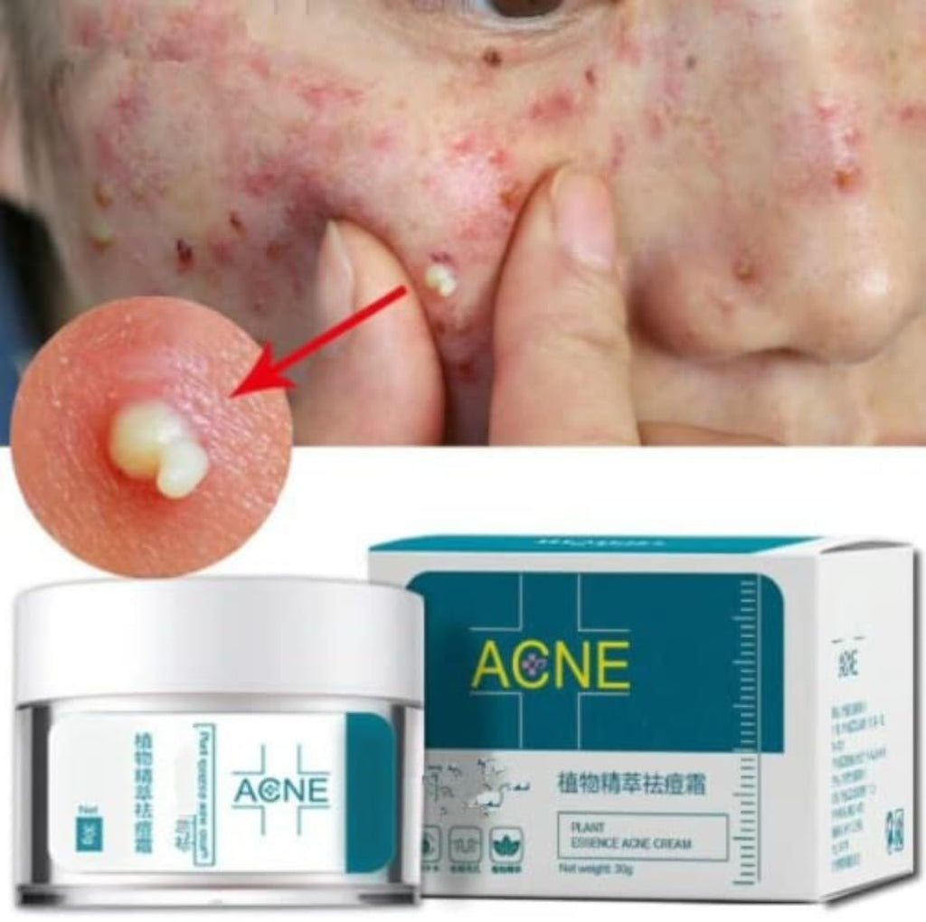 Crema Para El Acne ELIMINA Barros Espinillas Y Manchas RECUPERA Tu Piel LINDA