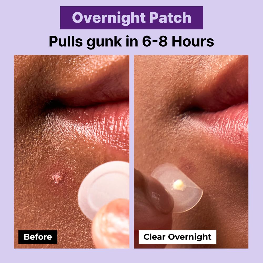 PGB A-CLEAR SPOT Pimple Patches. 3 Sizes – Day & Night Hydrocolloid Acne Patches – Invisible. Absorbs Zits & Blemishes. Korean Skin Care