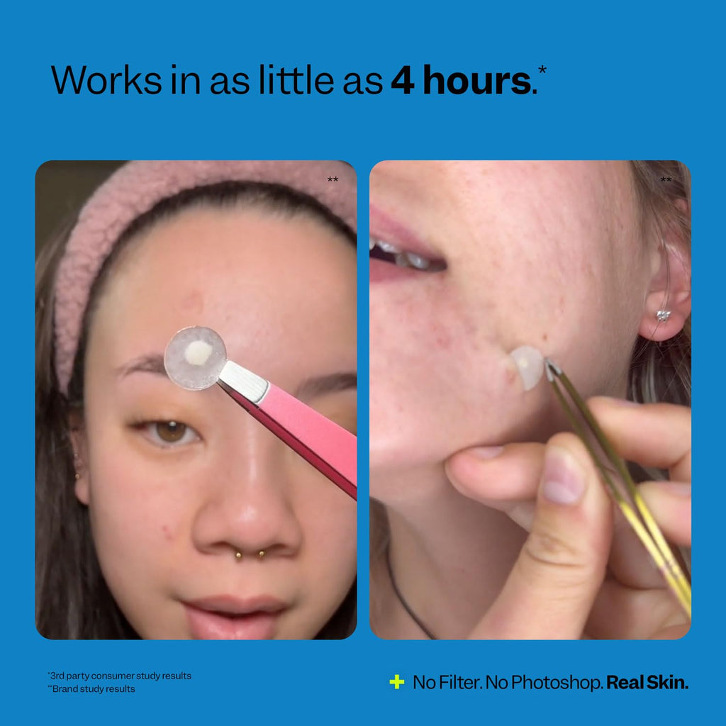 Peach Slices - Acne Spot Dots (30 ct) - Hydrocolloid Pimple Patches for Face - Absorb Gunk. Protect Picking & Support Healing - 3 Sizes (7. 10. & 12mm) - Vegan. Cruelty Free. Korean Skin Care & Beauty