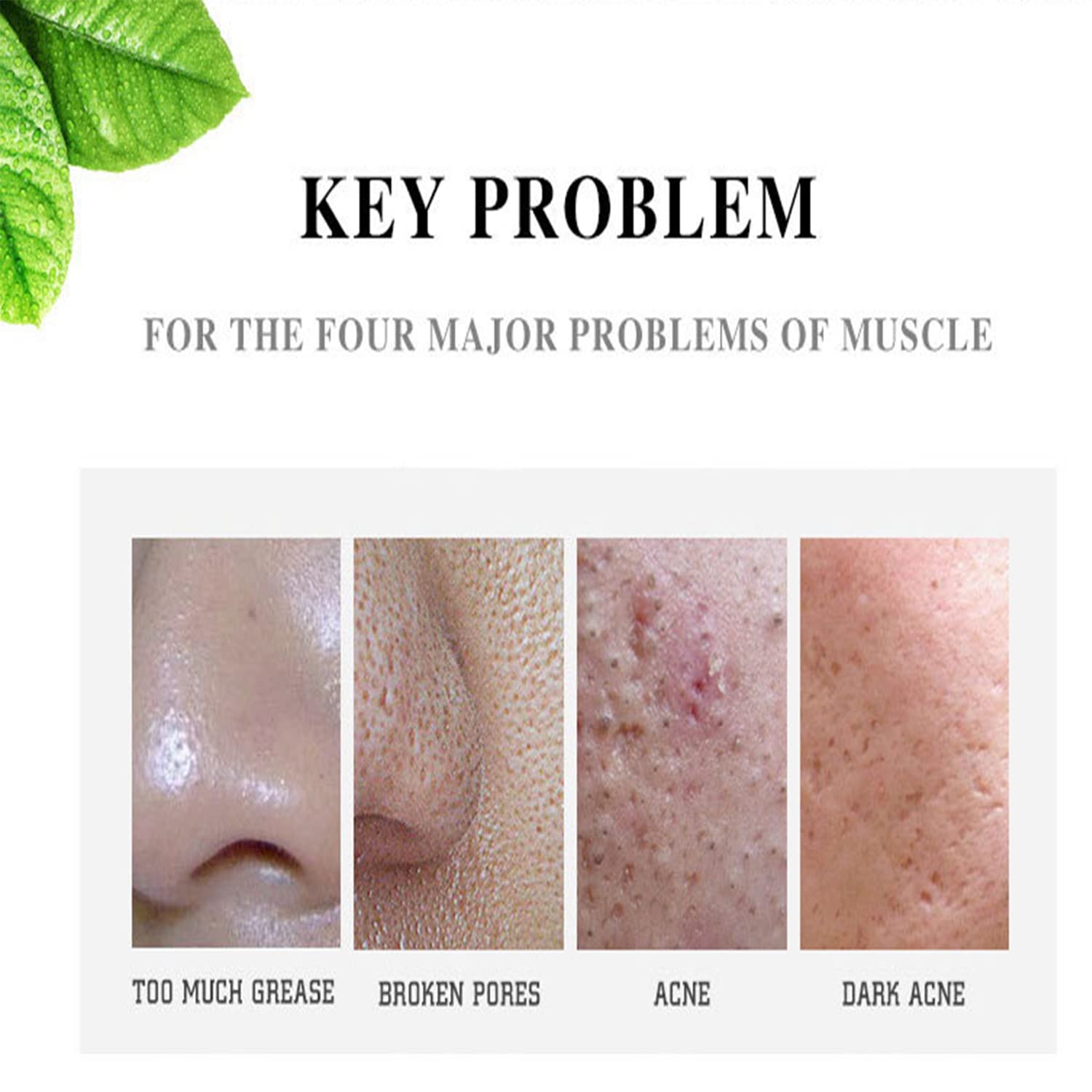 Face Acne Cleaning Cream Skin Care Remove Repair Comedone Pimple Acne Face Acne Cream 30ml/1.0fl.oz : Beauty & Personal Care