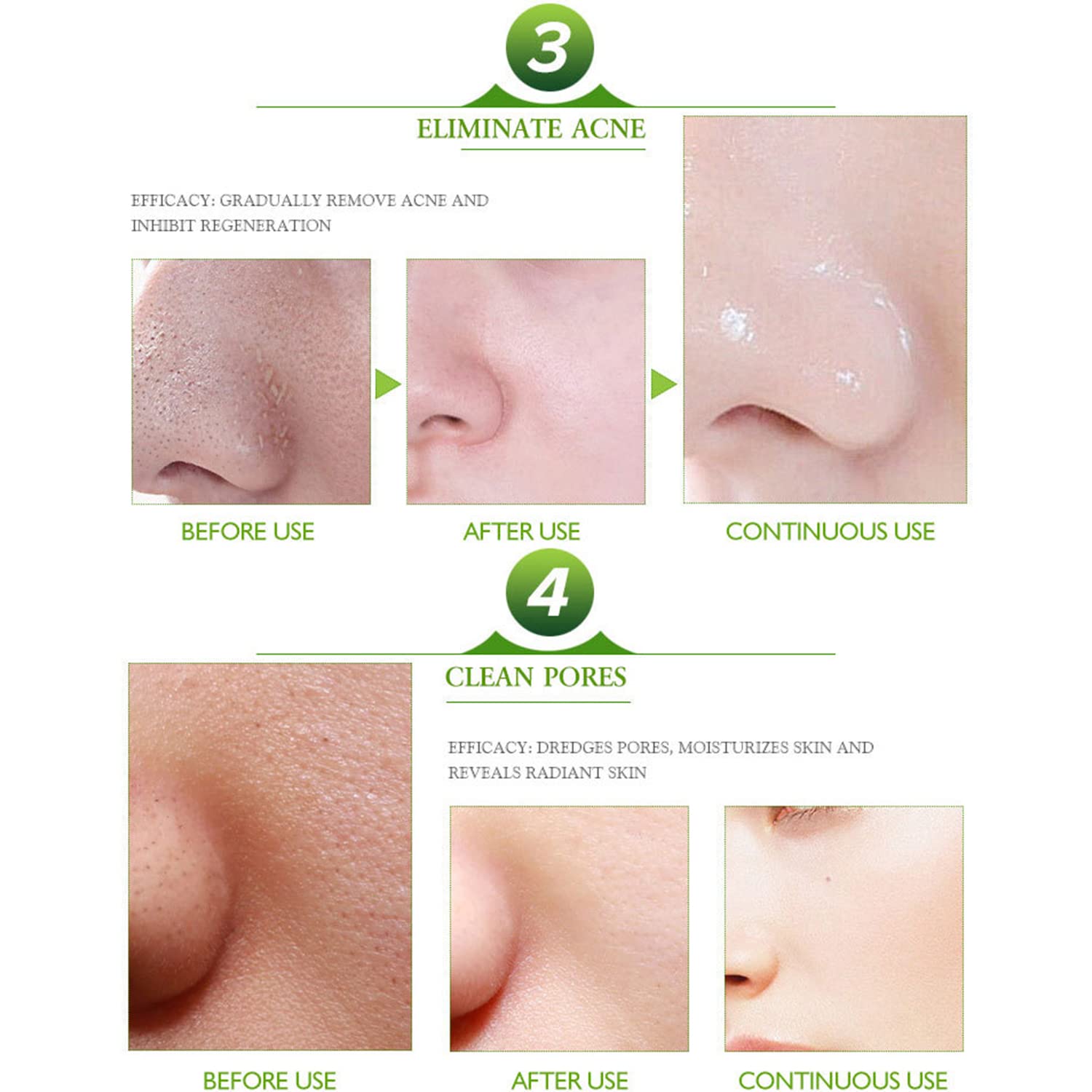 Face Acne Cleaning Cream Skin Care Remove Repair Comedone Pimple Acne Face Acne Cream 30ml/1.0fl.oz : Beauty & Personal Care