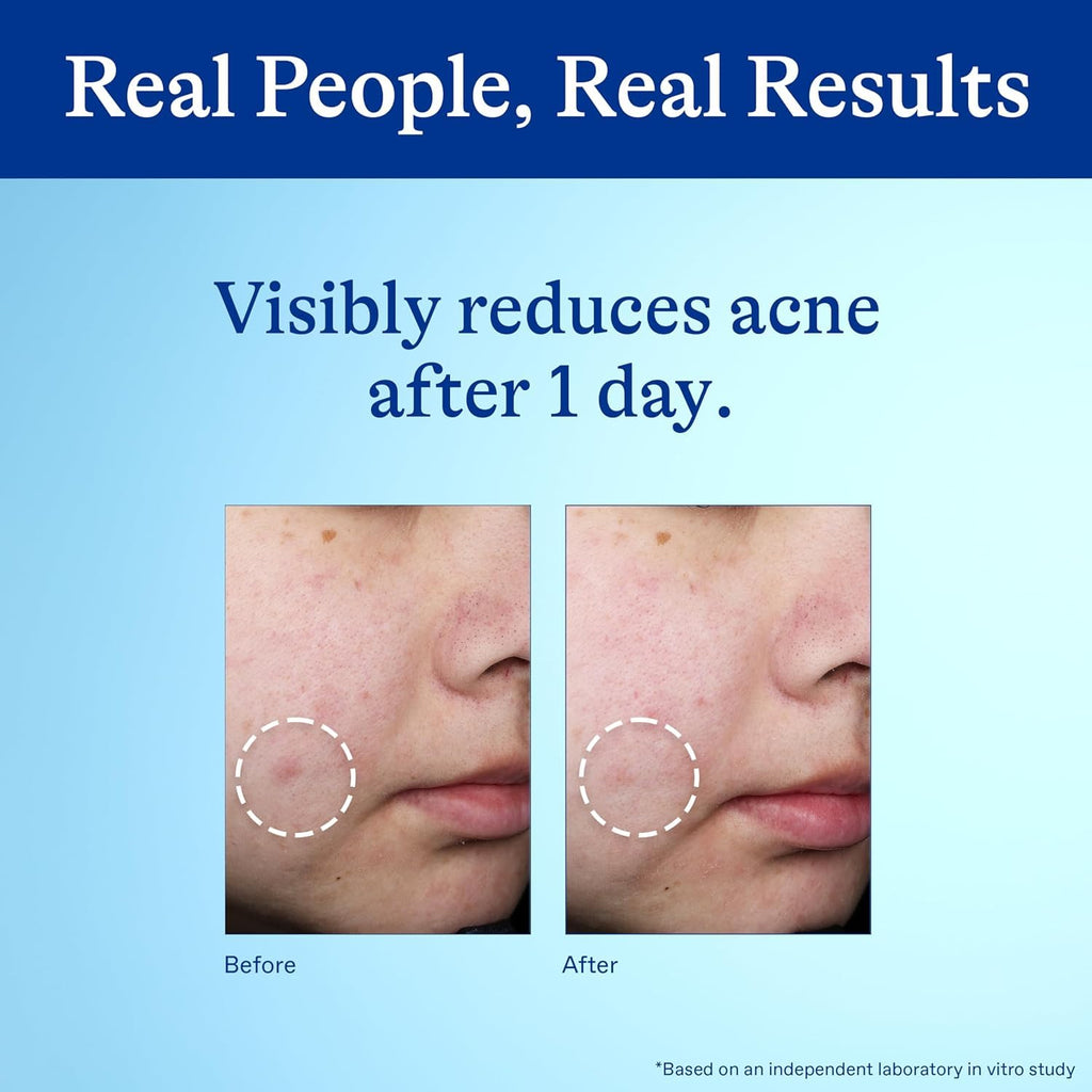 Differin Acne Spot Treatment with 10% Benzoyl Peroxide. Maximum Strength OTC Acne Treatment. Fast Acting Spot Treatment for Face. 1 oz : Beauty & Personal Care