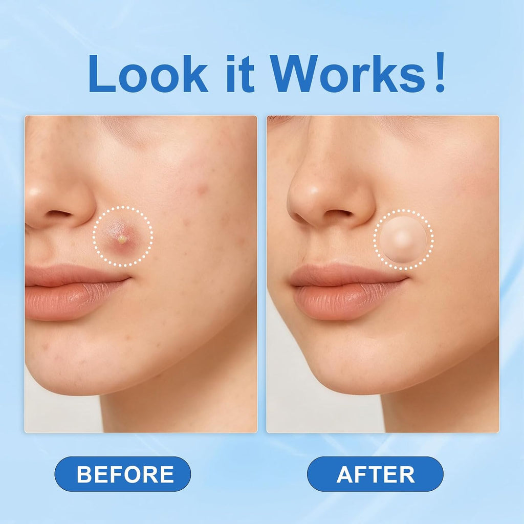 Amouy Acne Pimple Patch- 2 Sizes 612 Dots Thin & Thick Hydrocolloid Patches for Face with Witch Hazel. Tea Tree & Calendula Oil. Extra Adhesion Pimple Patches for Face Zit Patch Acne Dots : Beauty & Personal Care