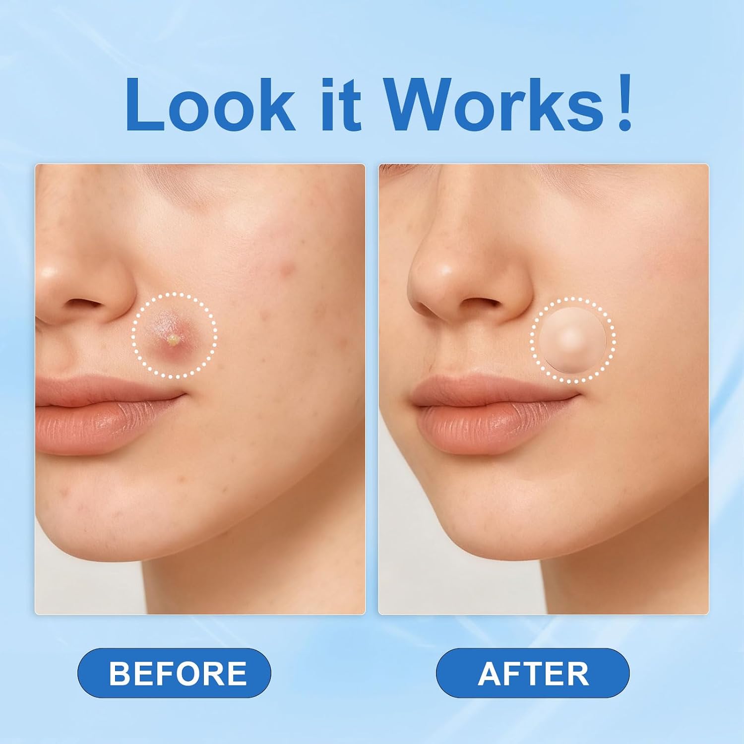 Amouy Acne Pimple Patch- 2 Sizes 612 Dots Thin & Thick Hydrocolloid Patches for Face with Witch Hazel. Tea Tree & Calendula Oil. Extra Adhesion Pimple Patches for Face Zit Patch Acne Dots : Beauty & Personal Care
