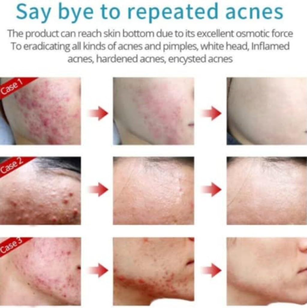 Crema Para El Acne ELIMINA Barros Espinillas Y Manchas RECUPERA Tu Piel LINDA