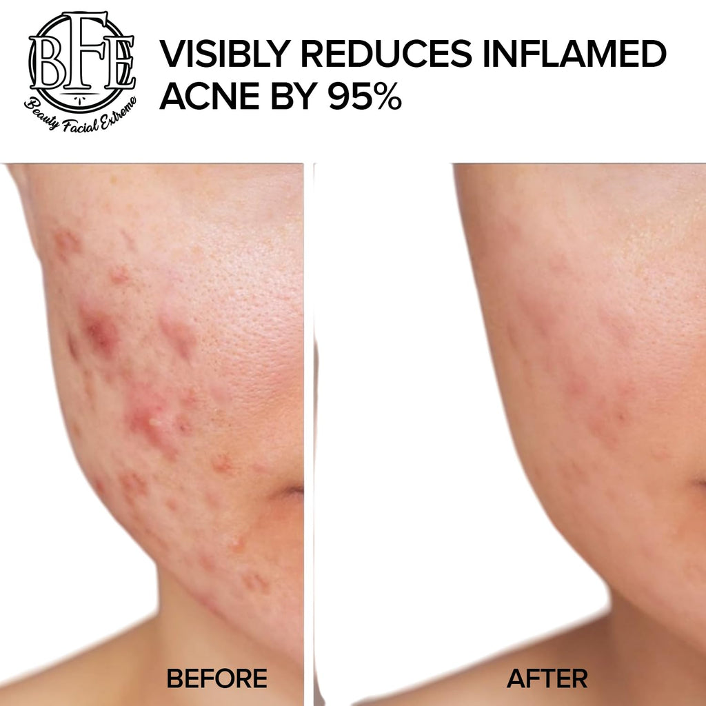 Acne Treatment Pads- Eliminates Cystic Breakouts. Oily Skin & Clogged Pores. Clear Pimple. Whitehead. Blackhead. Dark Spots & Improve Skin Texture. : Beauty & Personal Care