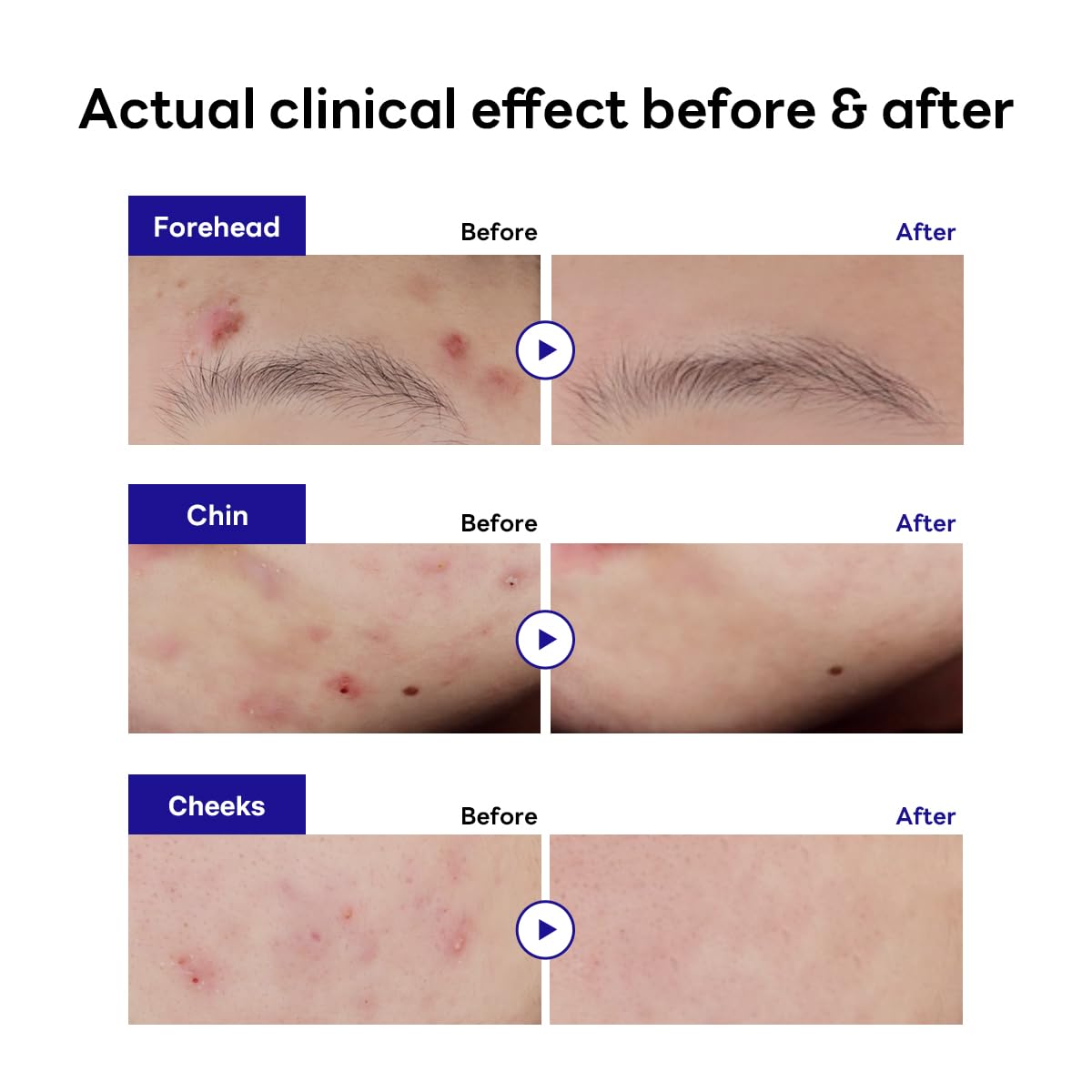 Mediheal Derma Clear Teatree Treatment Spot Patch (44 Counts) - Acne Relief. Oil and Moisture Balance with Teatree & Salicylic Acid
