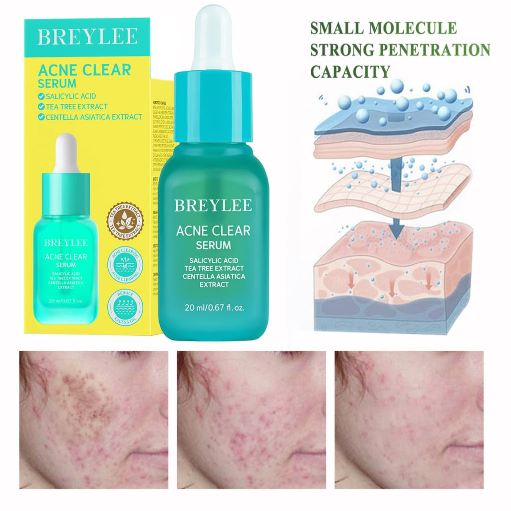 Tea Tree Acne Treatment Serum. Salicylic Acid & Centella Asiatica Serum for Severe Acne. Breakouts. Pimple Remover.Skin Repair (20ml.0.67oz)