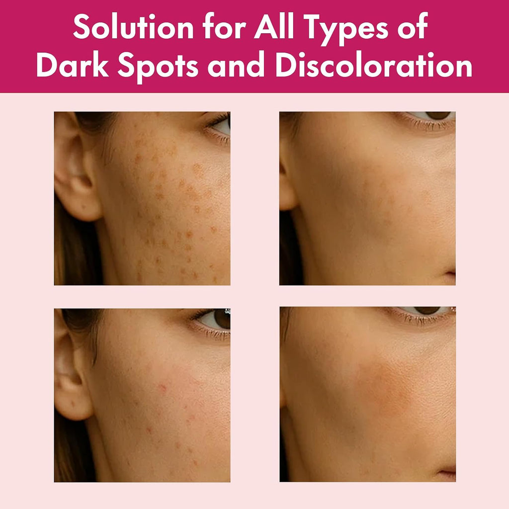 Roseblem Arbutin 7% + Tranexamic Acid 4% Face Cream for Dark Spots & Uneven Skin Tone – Hydrating. Non-Irritating. Safe for Sensitive Skin 1.76 oz (Pack of 1) : Beauty & Personal Care