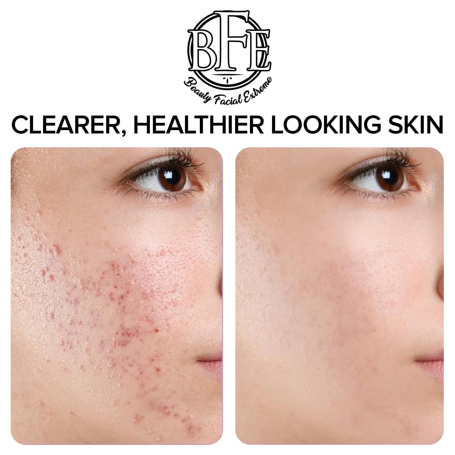 Acne Treatment Pads- Eliminates Cystic Breakouts. Oily Skin & Clogged Pores. Clear Pimple. Whitehead. Blackhead. Dark Spots & Improve Skin Texture. : Beauty & Personal Care