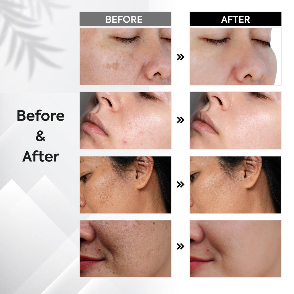 Dark Spot Remover for Face: Remove Sun & Age Spot Corrector – Melasma & Hyperpigmentation Brightening Serum for Body(Hand Leg Arm) – Brown Skin and Freckles Removal Treatment with Roller 15ml