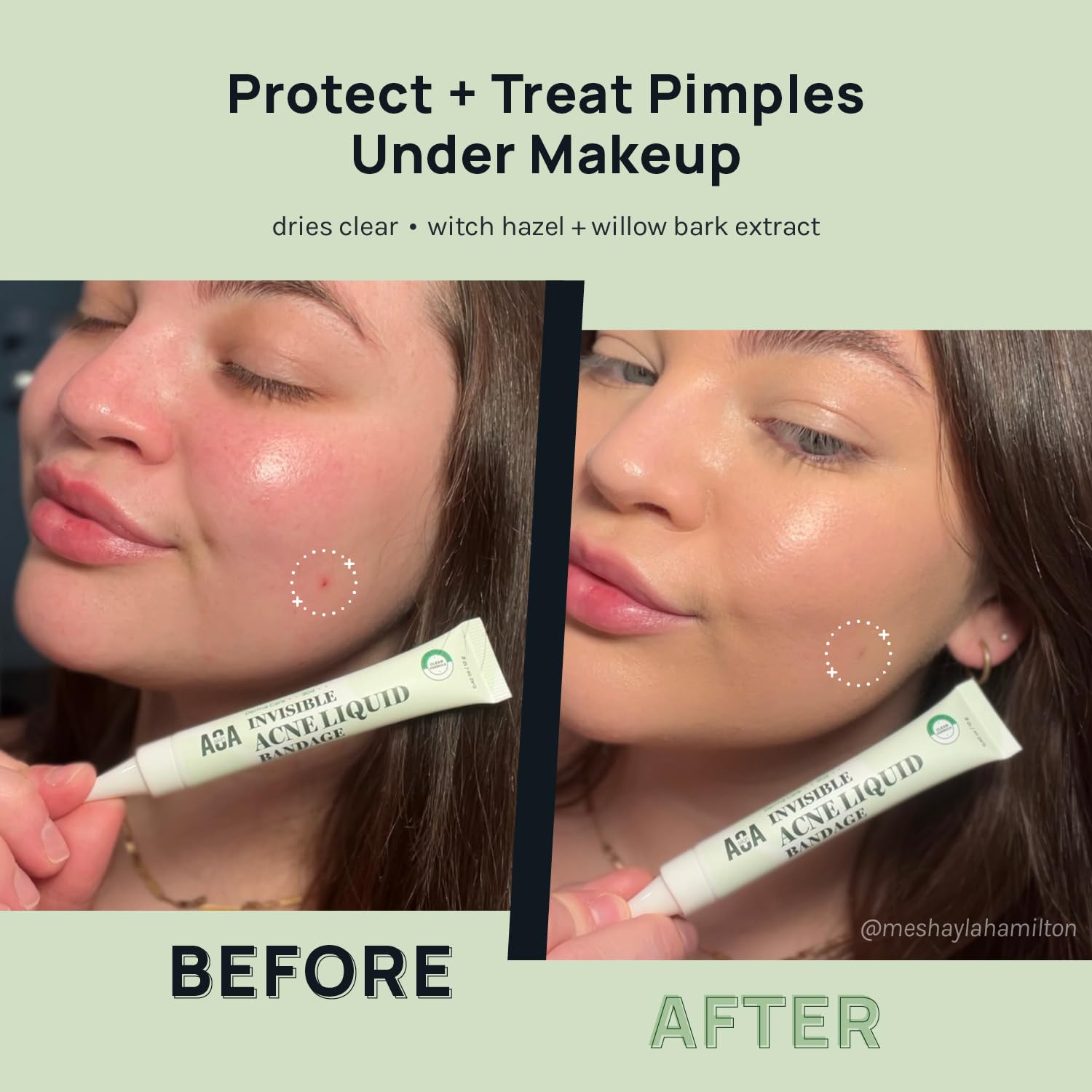Skin Invisible Acne Liquid Patch - Invisible Spot Treatment with Witch Hazel & Salicylic Acid. Liquid Pimple Patch. Clear Fits to Makeup | 0.42 Fl Oz. 12g : Beauty & Personal Care