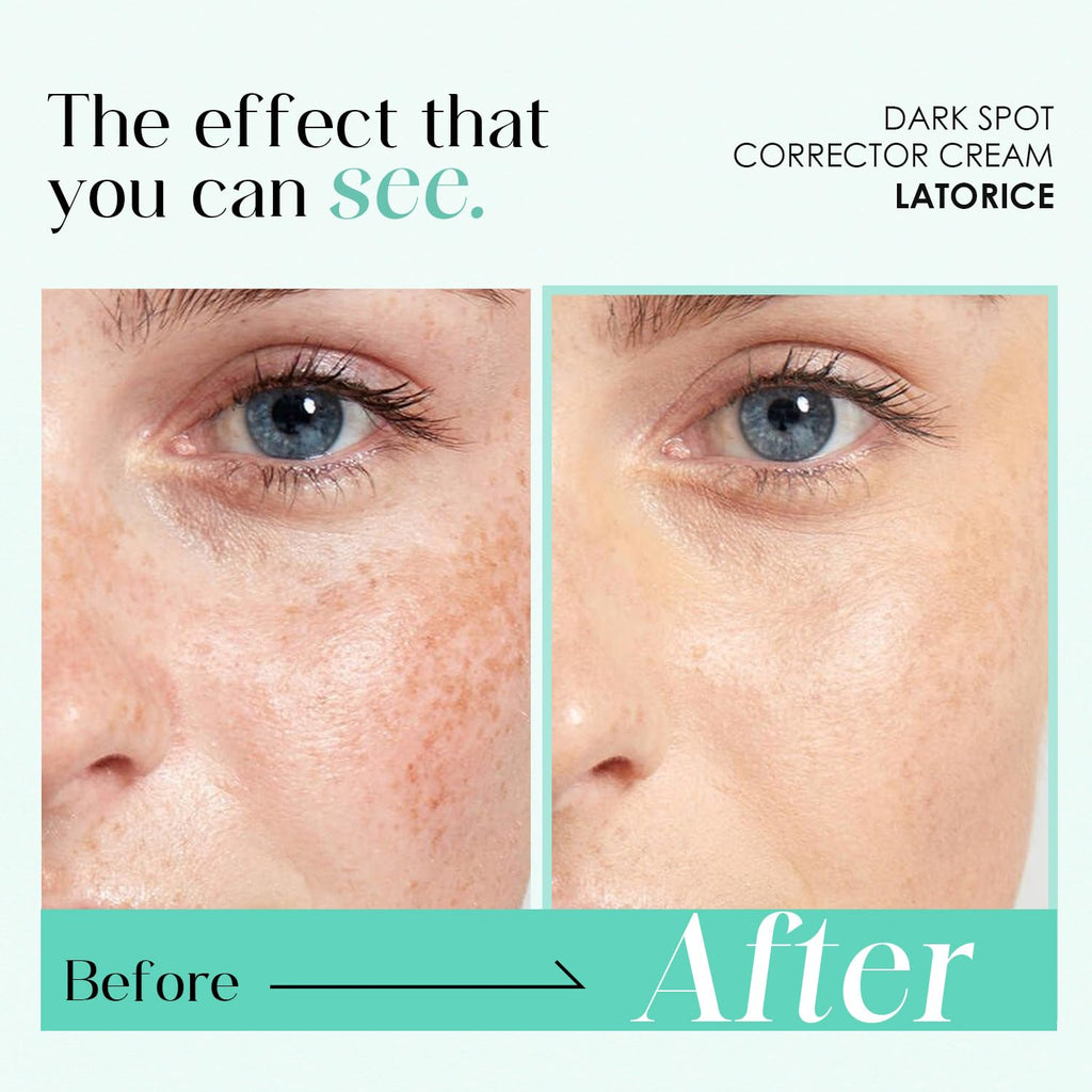 Dark Spot Remover for Face and Body: Tranexamic Acid Serum for Women and Men - Reduce Sun Spot Melasma Freckles (1.7 Fl Oz) : Beauty & Personal Care