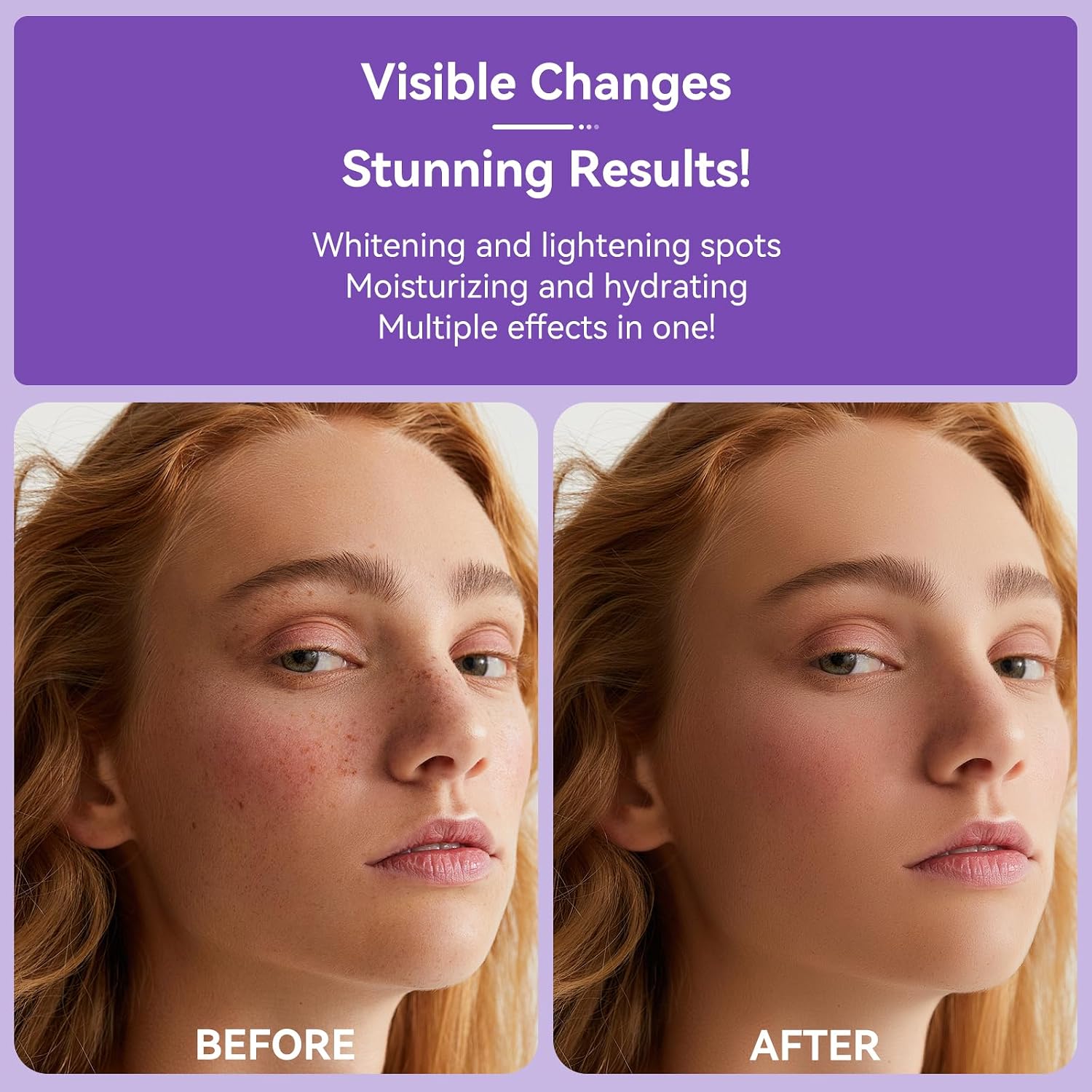 Dark Spot Remover for Face Body and Hands. Dark Spot Corrector for Melasma Age Spot Sun Spot. Brown Spot Remover for Women and Men with 360° Roller