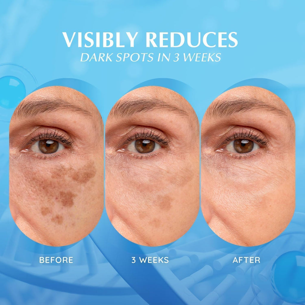 Dark Spot Remover for Face: Hyperpigmentation Body Treatment for Freckles Melasma Age Spot Sun Spot - Dark Spots Corrector Serum for Women and Men