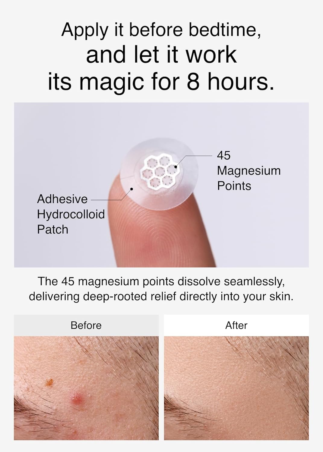 Quick Calming Magnesium Pimple Patches – Acne Spot Treatment with Tweezers & Ampoule. 10 Patches. Zit Sticker. Daewoong Pharmaceutical. Summer Season Travel Essentials