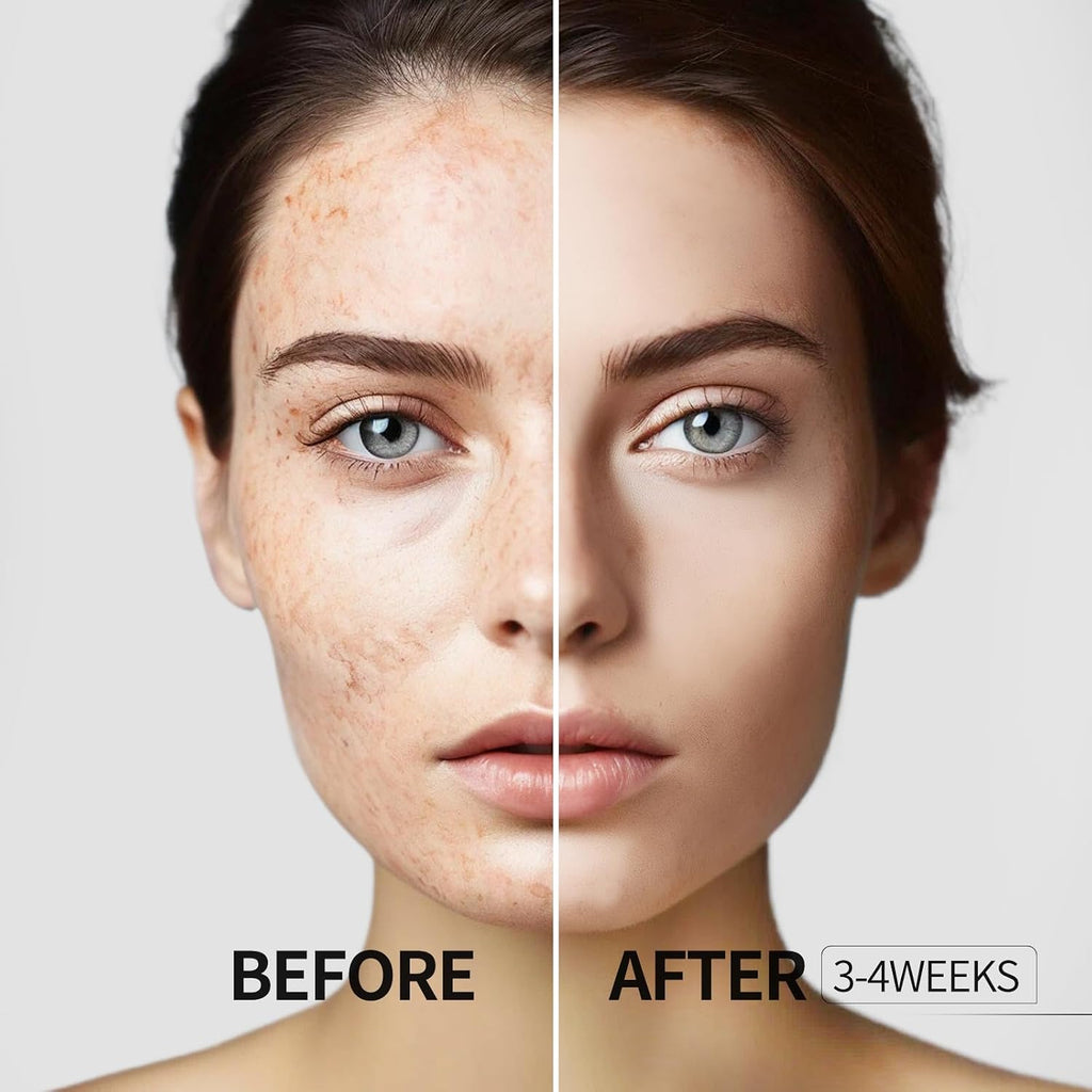 Dark Spot Remover for Face and Body. Dark Spot Corrector Serum. Age Spot Sun Spot Freckles Brown Spot Remover. Melasma Treatment for Face. Skin Care Serum with Roller : Beauty & Personal Care