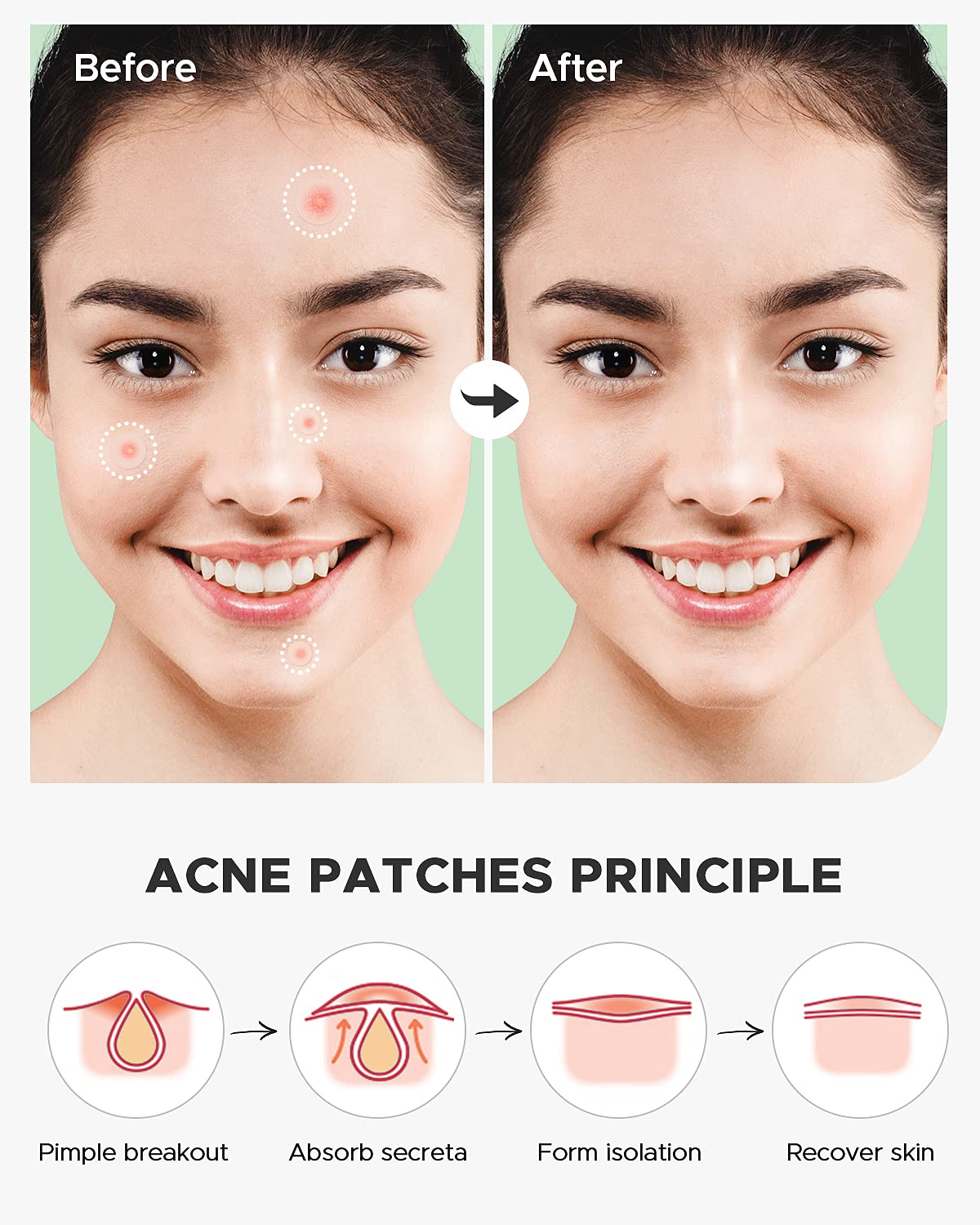 Pimple Patch (360 Counts 4 Sizes). Hydrocolliod Acne Patch for Face. Invisible Zit Patch with Tea Tree Oil & Calendula Oil. Blemish Patch