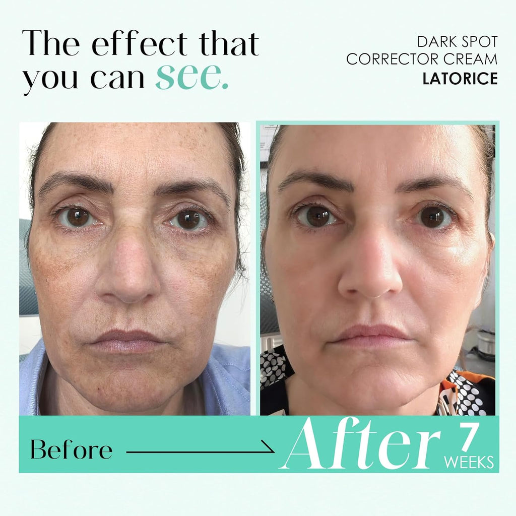 Dark Spot Remover for Face and Body: Tranexamic Acid Serum for Women and Men - Reduce Sun Spot Melasma Freckles (1.7 Fl Oz) : Beauty & Personal Care