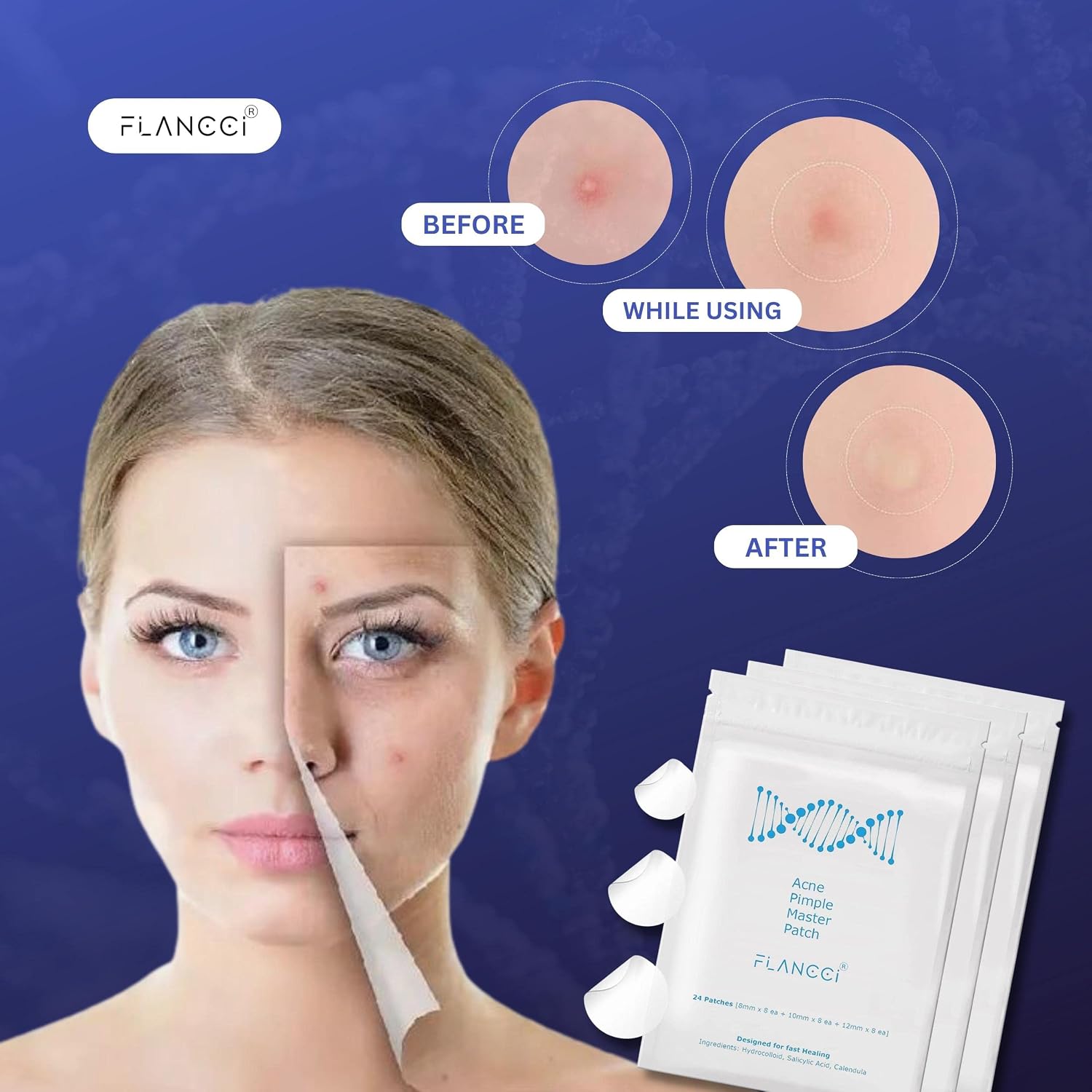 FLANCCI Pimple Patch Acne Patches Facial Skin Care Products. Blackhead Remover. Pimple Patch for Face and Hydrocolloid Acne Treatment Patch Salicylic Acid. Acne Spot Treatment (120 Count (Pack of 5))