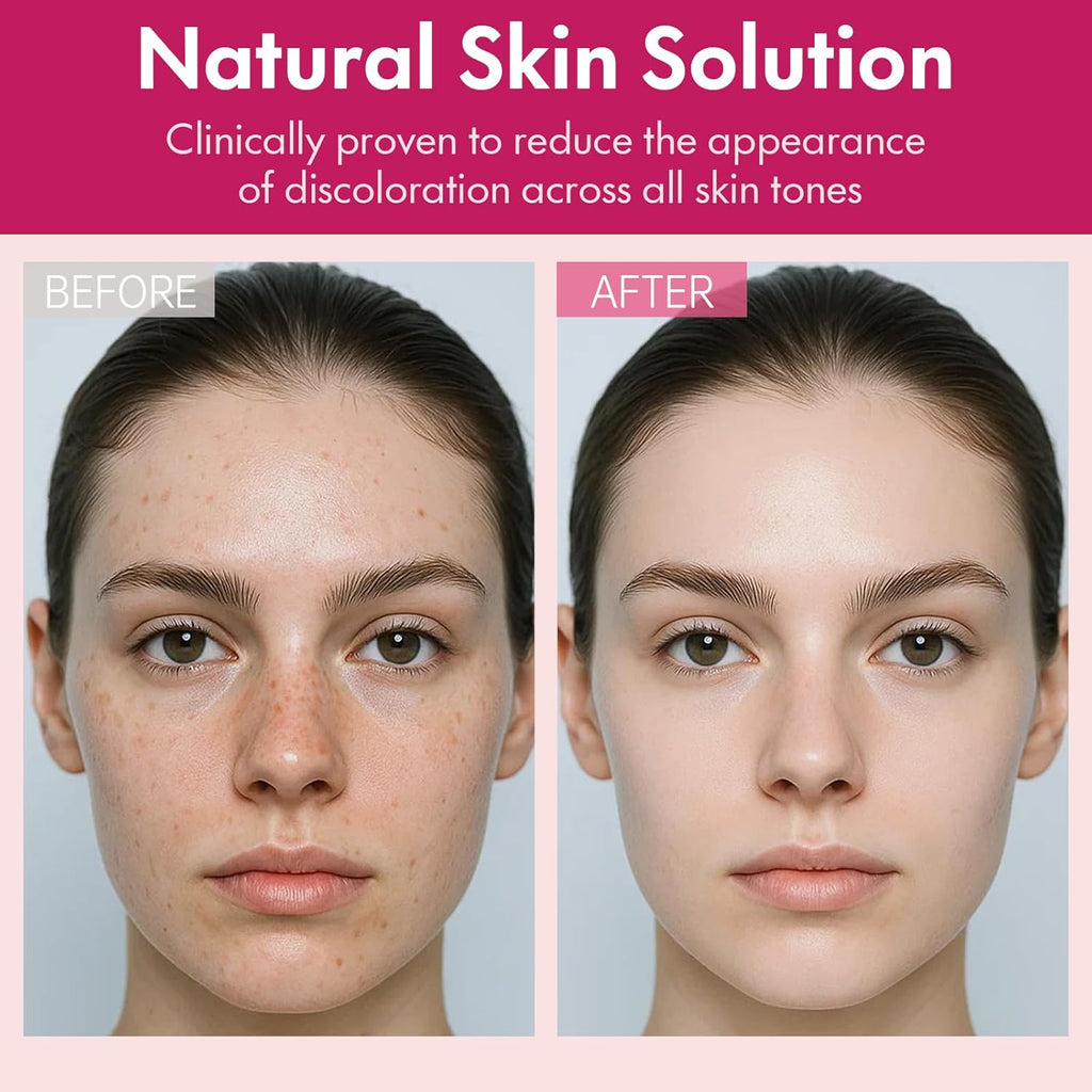 Roseblem Arbutin 7% + Tranexamic Acid 4% Face Cream for Dark Spots & Uneven Skin Tone – Hydrating. Non-Irritating. Safe for Sensitive Skin 1.76 oz (Pack of 1) : Beauty & Personal Care