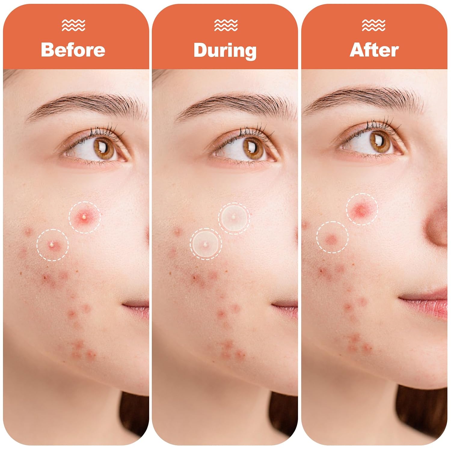 Cabiuty Large Pimple Patches for Face. 3 Sizes Hydrocolloid Acne Patches for Zits and Blemishes on Face. Chin. Back. All Skin Types