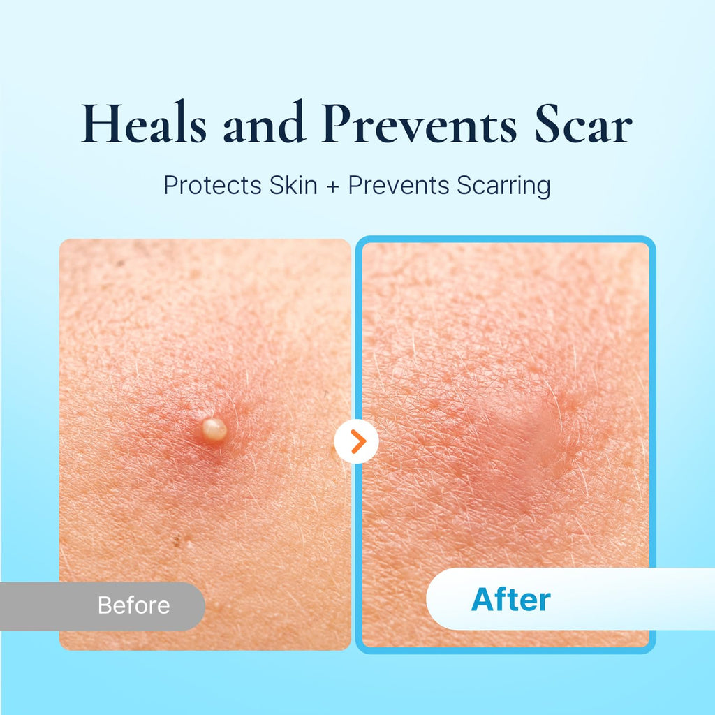 DERMAKR Discreet Acne Pimple Patch | Spot Cover Treatment Solution Cystic Acne Pimple Scars | Hydrocolloid Facial Stickers | Waterproof Patches Quick Healing Pimples
