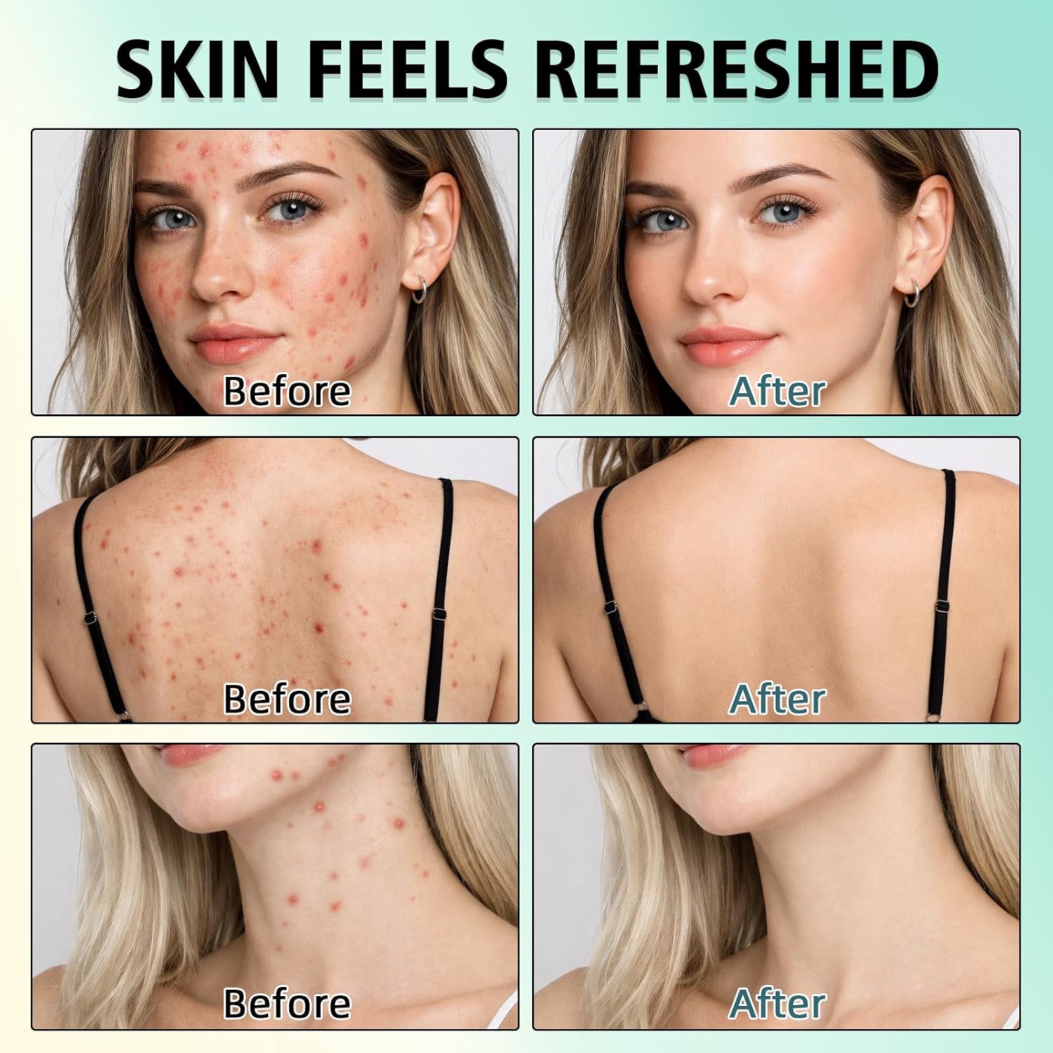 Acne Treatment for Face. SalicylicAcid Cream. Blemish Care Formula for Skin Types. Pimple Treatment for Face & Body. Gentle Daily Care for Oily & Blemish Prone Complexions. Helps Improve Appearance