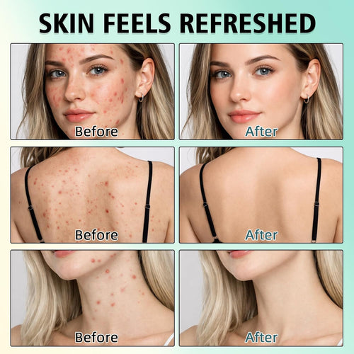 Acne Treatment for Face. SalicylicAcid Cream. Blemish Care Formula for Skin Types. Pimple Treatment for Face & Body. Gentle Daily Care for Oily & Blemish Prone Complexions. Helps Improve Appearance