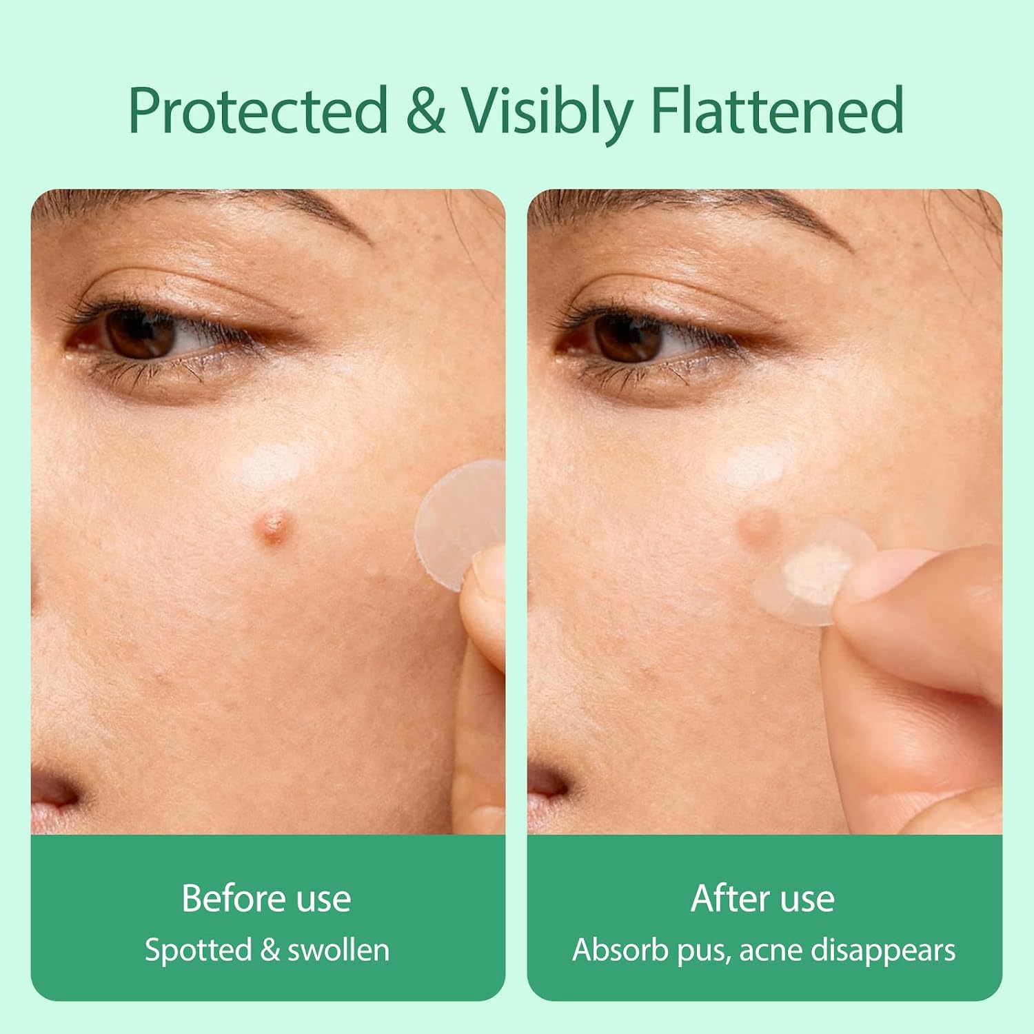 Anchiray Pimple Patches. Acne Patches. Invisible Pimple and Acne Treatment for Face with Hydrocolloid. Tea Tree Oil. Salicylic Acid & Calendula Extract.Fast-Acting.All Skin Types.3 Sizes
