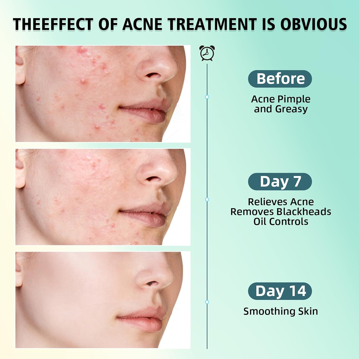 Acne Treatment for Face. SalicylicAcid Cream. Blemish Care Formula for Skin Types. Pimple Treatment for Face & Body. Gentle Daily Care for Oily & Blemish Prone Complexions. Helps Improve Appearance