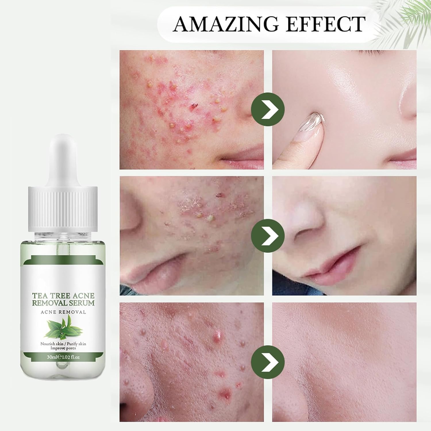 Acne Removing Facial Serum.Natural Ingredients Professionally Remove Acne Marks.For Teens & Adults Anti-acne Moisturizer Acne Removal Serum : Beauty & Personal Care