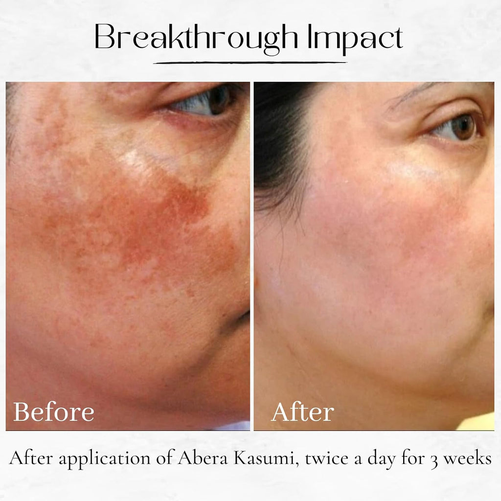 Kasumi Glowing Cream. Melasma Treatment with Niacinamide & HA. Dark Spot Remover For Face. Reduce Fine Lines. Wrinkles. Anti-aging. Red Ginseng Extract. Melasma Cream (0.7 Oz Per Item) : Beauty & Personal Care
