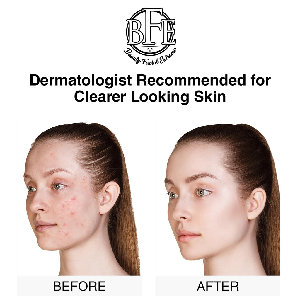 Acne Treatment Pads- Eliminates Cystic Breakouts. Oily Skin & Clogged Pores. Clear Pimple. Whitehead. Blackhead. Dark Spots & Improve Skin Texture. : Beauty & Personal Care
