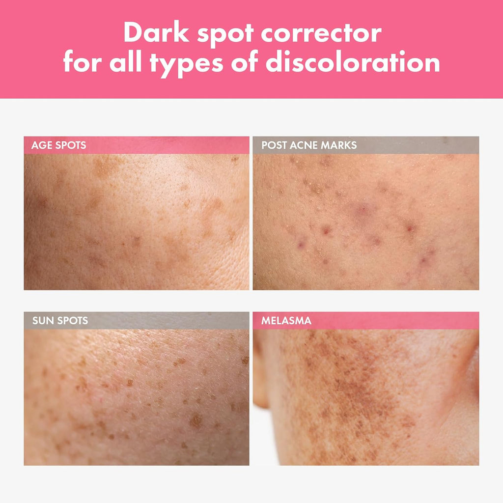 Arbutin 7% Intensive Spot Cream with 70.000ppm Arbutin. 3% Tranexamic Acid. 1% Niacinamide. Glutathione. Dark Spots. freckle. Blemishes. Anti-pigmentation. Korean Skin Care. 20ml. 0.67 fl.oz : Beauty & Personal Care