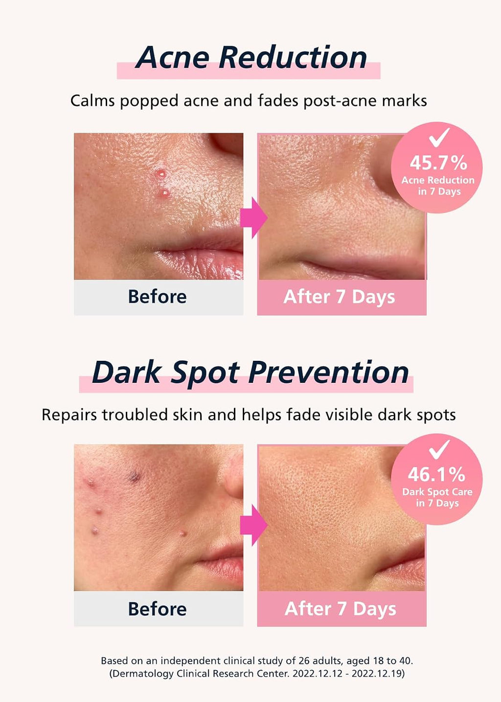 DWEasyDerm EasyDerm Real Calming Pimple Patches. Clear | Niacinamide. Hyaluronic Acid. EGF Acne Dark Spot Care. K-beauty | 6 counts. Micro Point length : 285μm. Summer & Travel Essentials