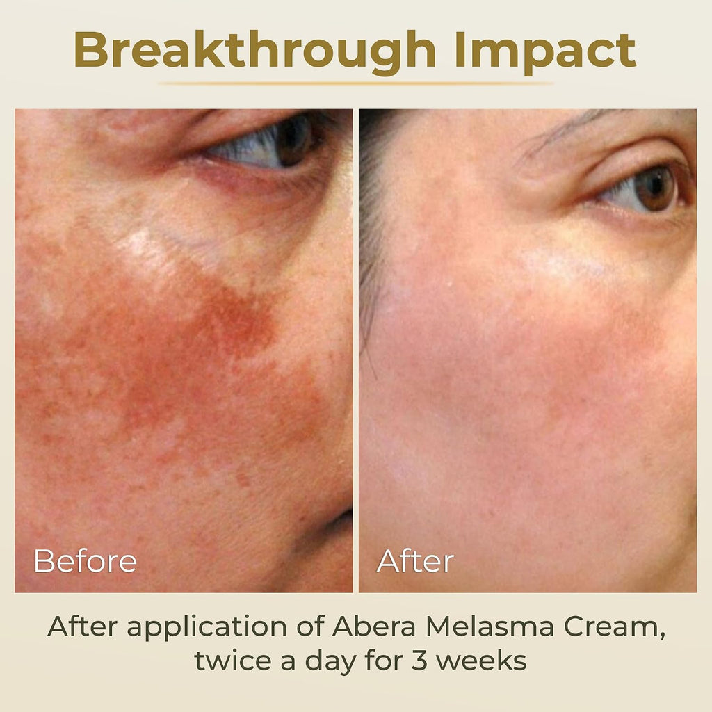 Melasma Cream. Dark Spot Corrector - Melasma. Freckle. Sun Spot. Age Spot Remover Advanced Formula for Women and Men (0.7 Oz Per Item) : Beauty & Personal Care