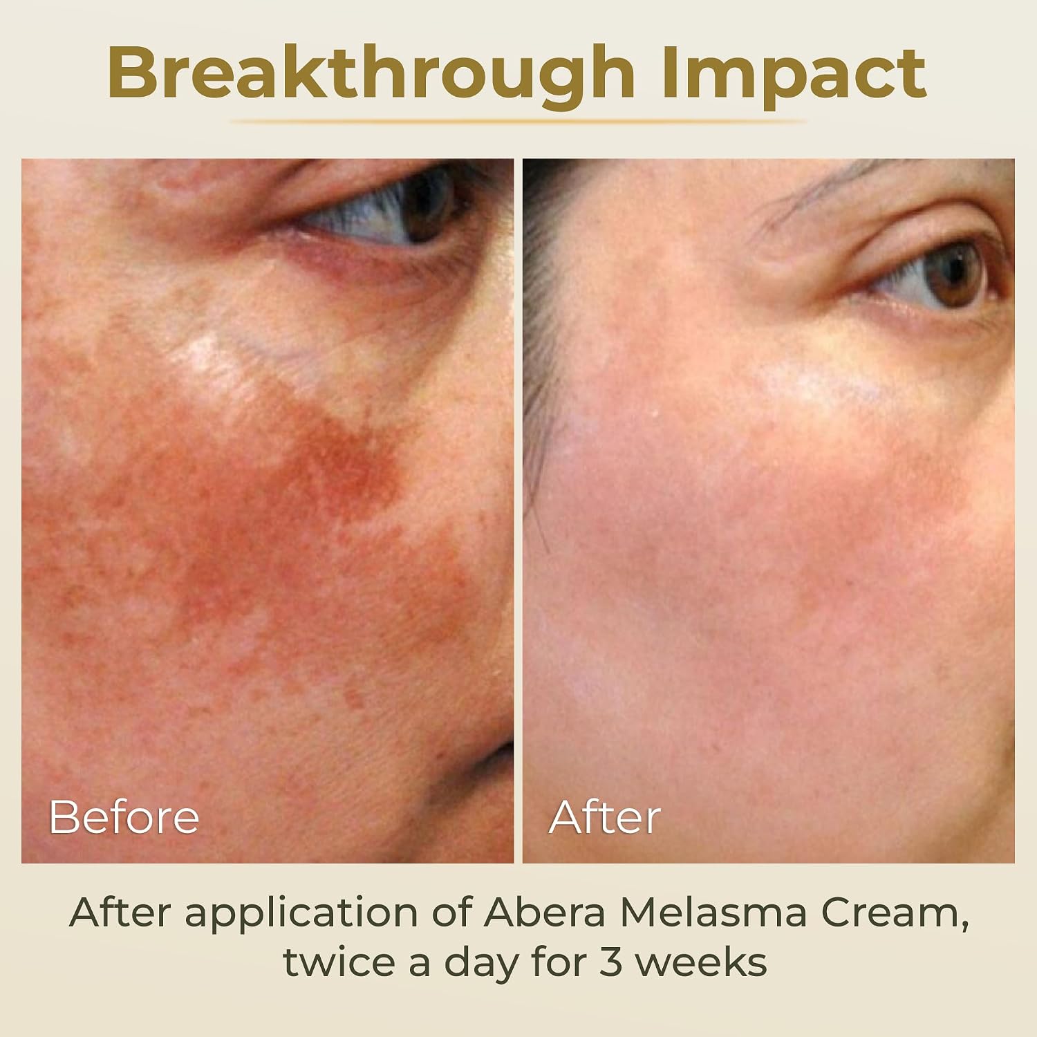 Melasma Cream (Premium Version) - Dark Spot Corrector. Melasma. Freckle. Sun Spot. Age Spot Remover Advanced Formula for Women and Men (0.7 Oz Per Item) : Beauty & Personal Care
