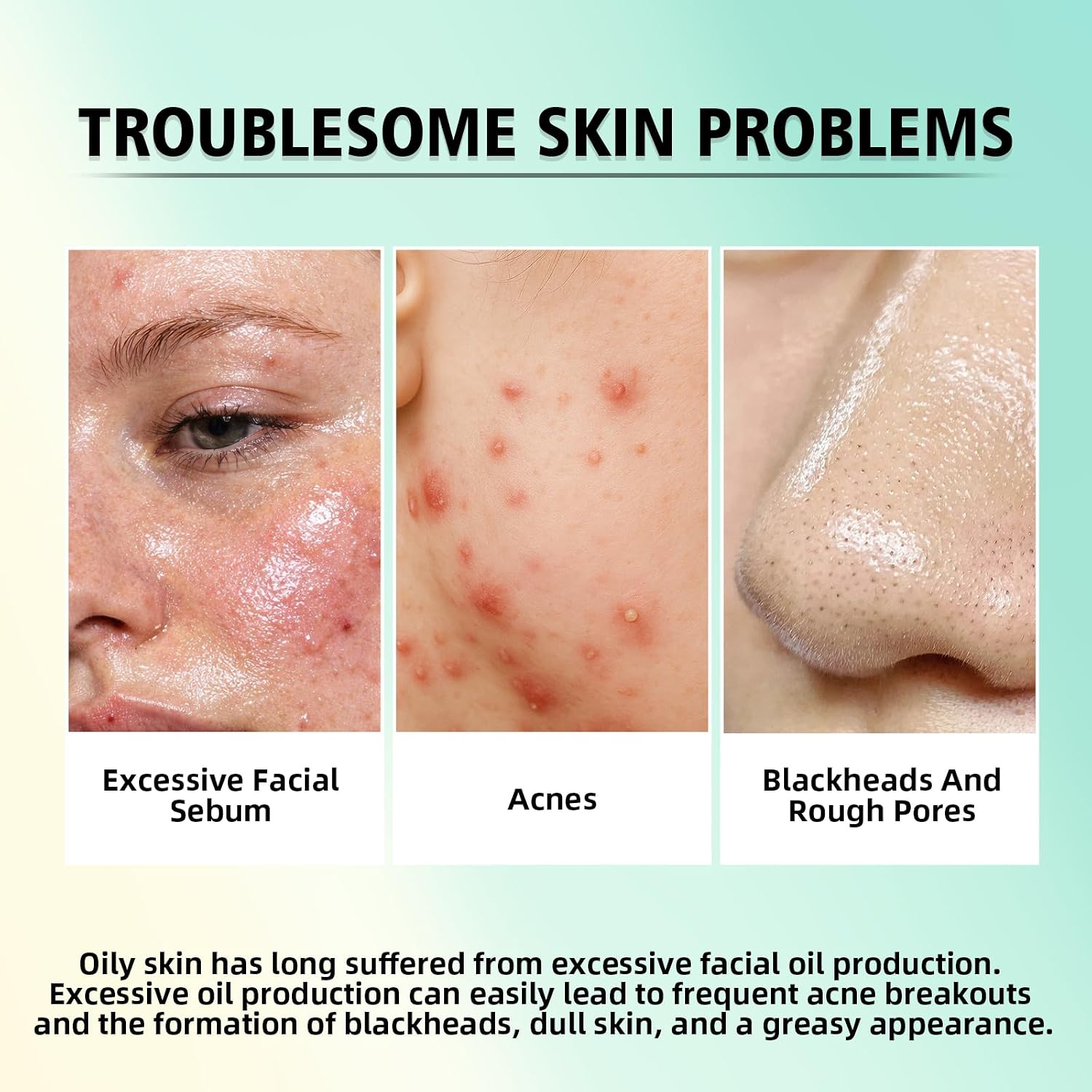 Acne Treatment for Face. SalicylicAcid Cream. Blemish Care Formula for Skin Types. Pimple Treatment for Face & Body. Gentle Daily Care for Oily & Blemish Prone Complexions. Helps Improve Appearance