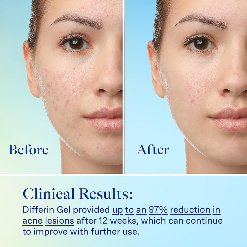 Acne Skin Care Kit. Differin Gel Retinoid Acne Treatment for Face with 0.1% Adapalene & 5% Benzoyl Peroxide Face Wash & Body Wash. Designed for Pimple and Acne Prone Skin