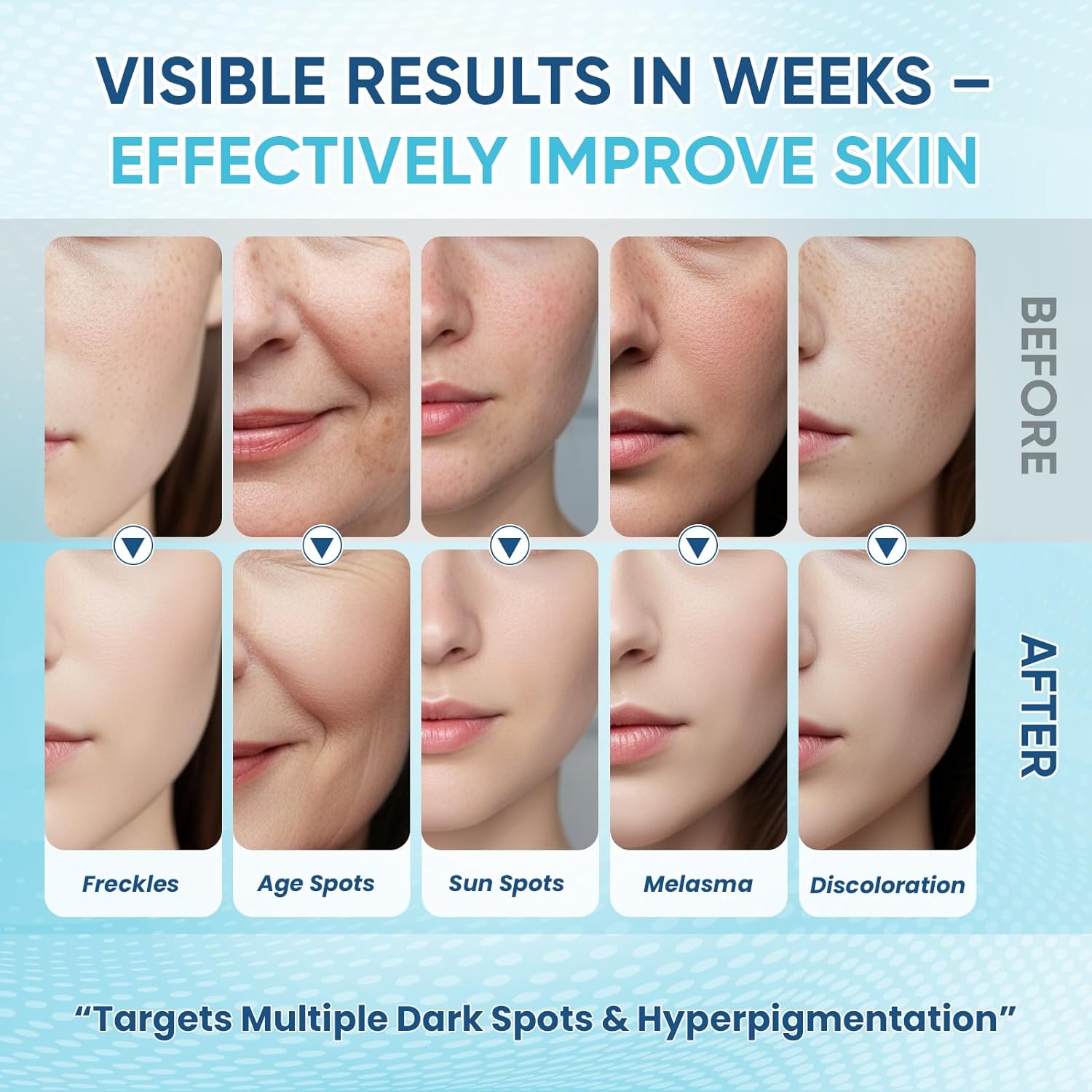 Hyperpigmentation Treatment Skin Brown Spot Age Spot Remover : Beauty & Personal Care