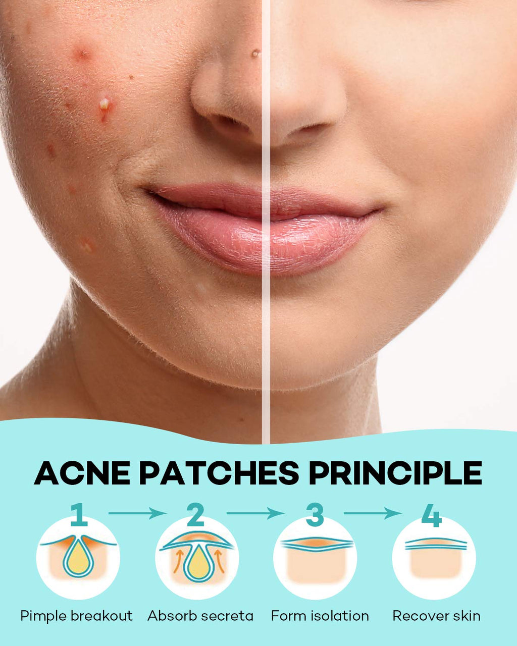 TKTK Pimple Patch Acne Patch. 4 Sizes 140 Patches Acne Absorbing Cover Patch. Hydrocolloid Invisible Acne Patches for Face Zit Patch Acne Dots Tea Tree. Calendula Oil