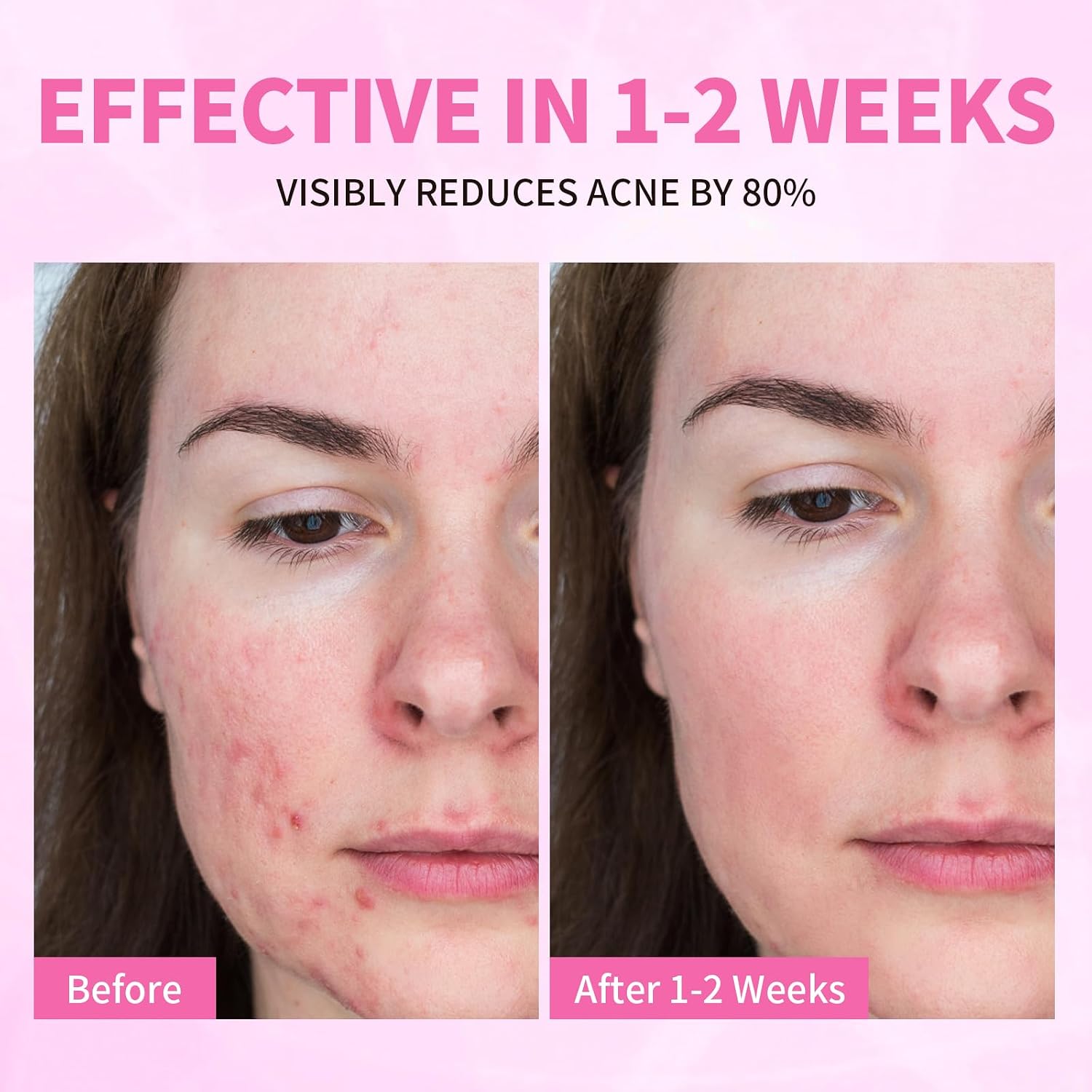 Acne Serum for Face. Back and Body. Gentle Skin Care for Acne Prone Sensitive Skin | For Women & Men : Beauty & Personal Care