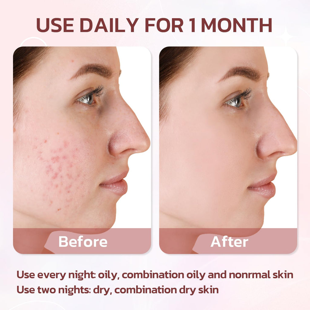 Effective Acne Treatment for Face - Acne Drying lotion - Removes Acne and Redness - Eliminating Zits - Pimple Drying Lotion 1 Fl oz