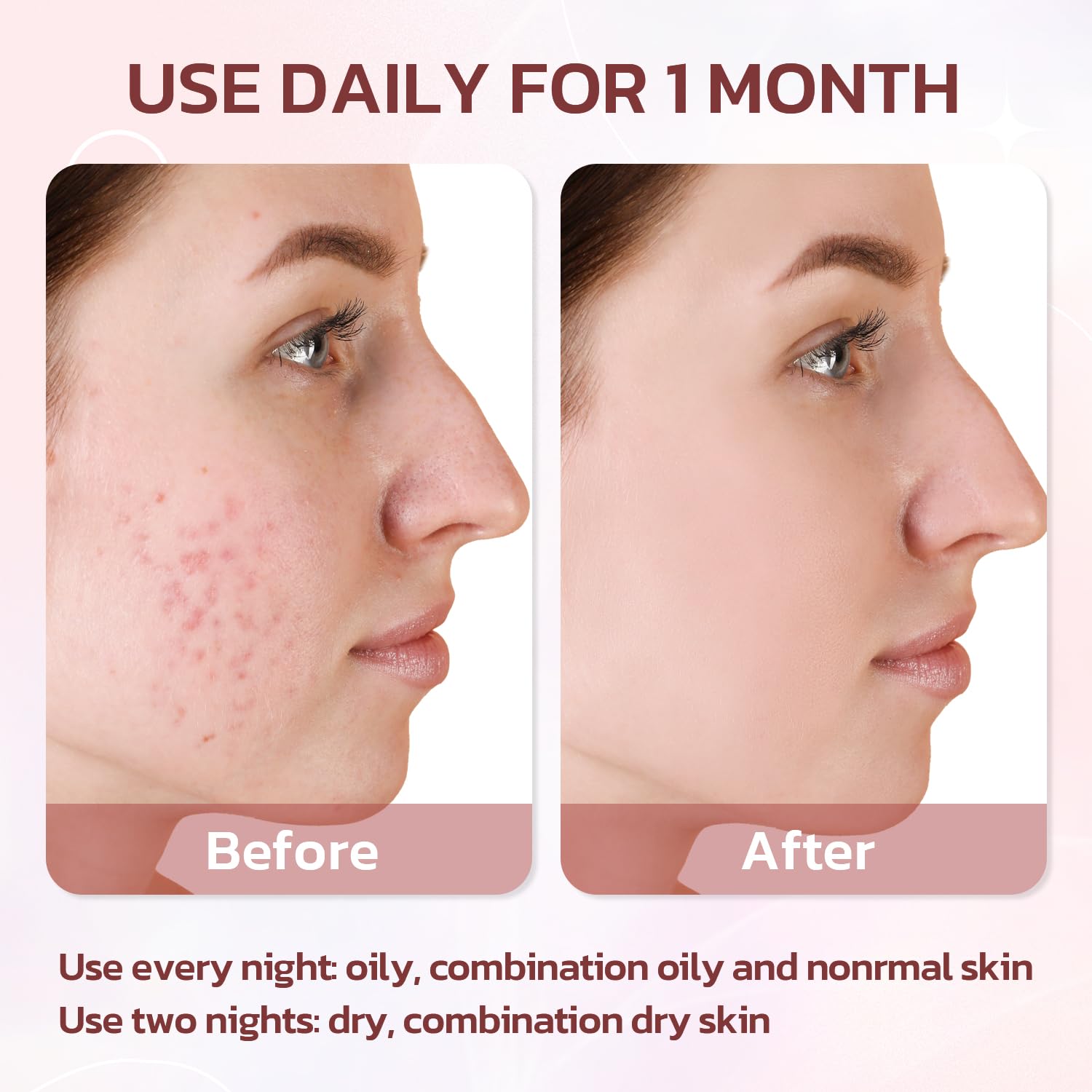 Effective Acne Treatment for Face - Acne Drying lotion - Removes Acne and Redness - Eliminating Zits - Pimple Drying Lotion 1 Fl oz