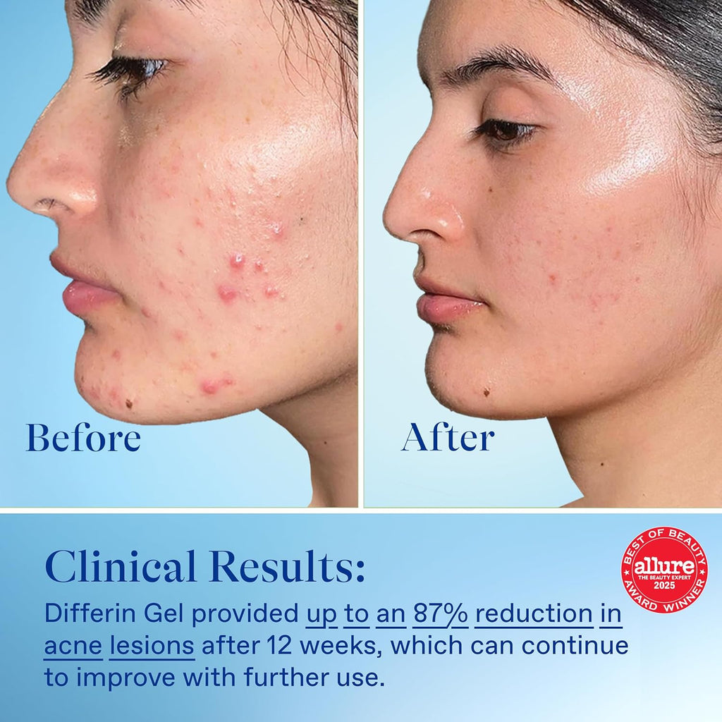 Acne Treatment Gel. 60 Day Supply. Retinoid Treatment for Face with 0.1% Adapalene. Gentle Skin Care for Acne Prone Sensitive Skin.